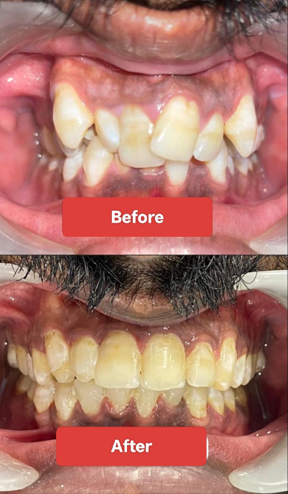 Teeth Alignment Portrait Case 3